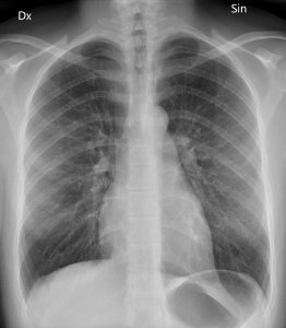 Normal posteroanterior (PA) chest radiograph (X-ray) photo