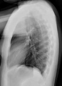 Normal lateral chest radiograph (X-ray) photo