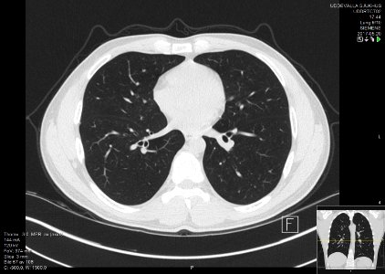 High-resolution computed tomograph of a normal thorax, axial plane (57)