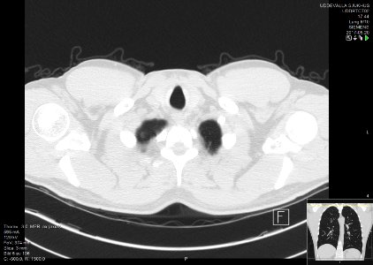 High-resolution computed tomograph of a normal thorax, axial plane (5)