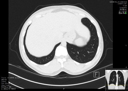 High-resolution computed tomograph of a normal thorax, axial plane (92)