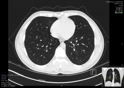High-resolution computed tomograph of a normal thorax, axial plane (66)