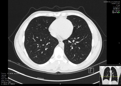 High-resolution computed tomograph of a normal thorax, axial plane (64)
