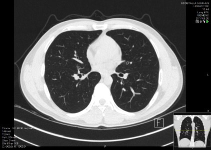 High-resolution computed tomograph of a normal thorax, axial plane (53)
