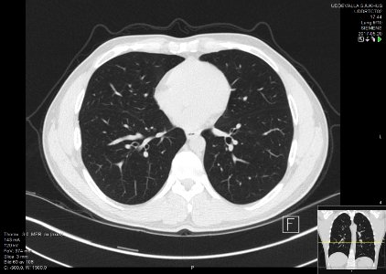 High-resolution computed tomograph of a normal thorax, axial plane (60)