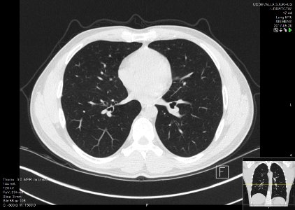 High-resolution computed tomograph of a normal thorax, axial plane (56)