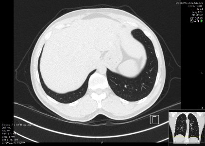 High-resolution computed tomograph of a normal thorax, axial plane (93)