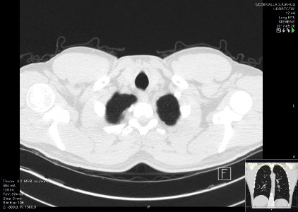 High-resolution computed tomograph of a normal thorax, axial plane (6)