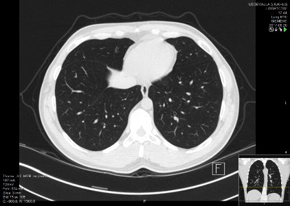High-resolution computed tomograph of a normal thorax, axial plane (75)