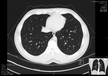 High-resolution computed tomograph of a normal thorax, axial plane (74)