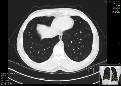High-resolution computed tomograph of a normal thorax, axial plane (77)