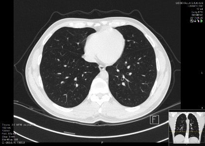 High-resolution computed tomograph of a normal thorax, axial plane (68)