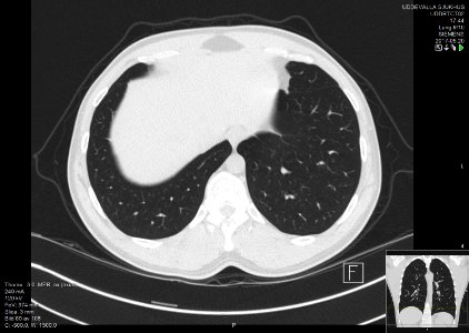 High-resolution computed tomograph of a normal thorax, axial plane (82)
