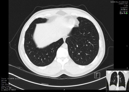 High-resolution computed tomograph of a normal thorax, axial plane (80)