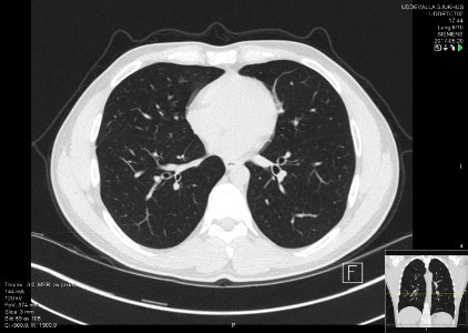 High-resolution computed tomograph of a normal thorax, axial plane (59)