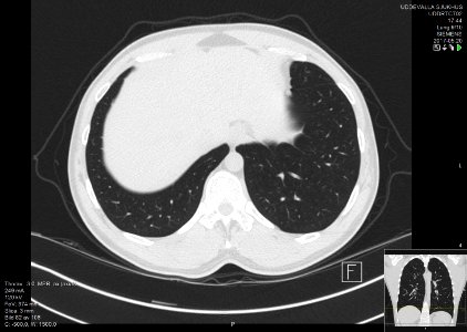 High-resolution computed tomograph of a normal thorax, axial plane (85)
