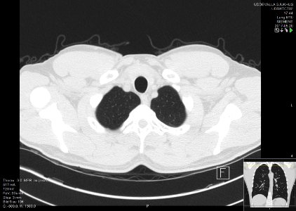 High-resolution computed tomograph of a normal thorax, axial plane (9)