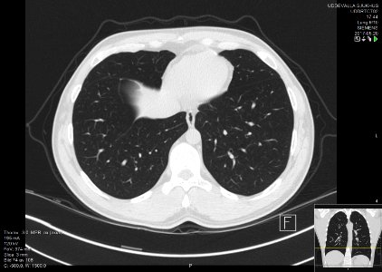 High-resolution computed tomograph of a normal thorax, axial plane (76)