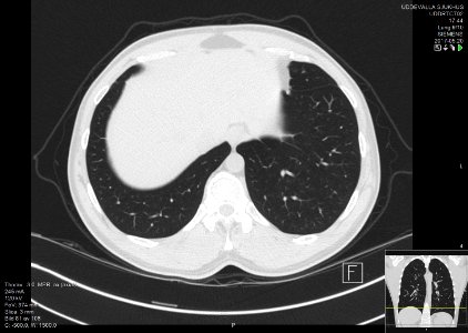 High-resolution computed tomograph of a normal thorax, axial plane (83)