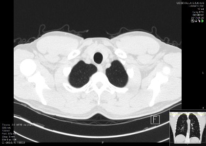 High-resolution computed tomograph of a normal thorax, axial plane (8)