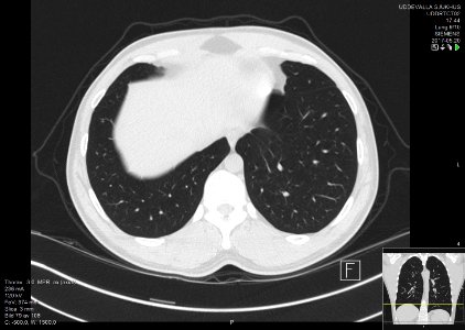 High-resolution computed tomograph of a normal thorax, axial plane (81)