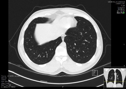 High-resolution computed tomograph of a normal thorax, axial plane (79)