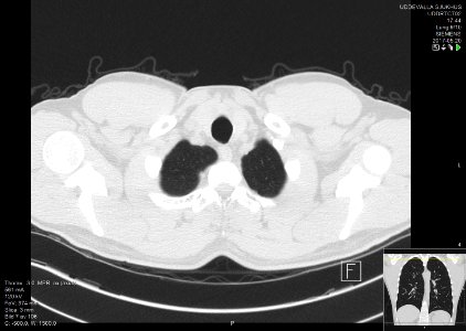 High-resolution computed tomograph of a normal thorax, axial plane (7)