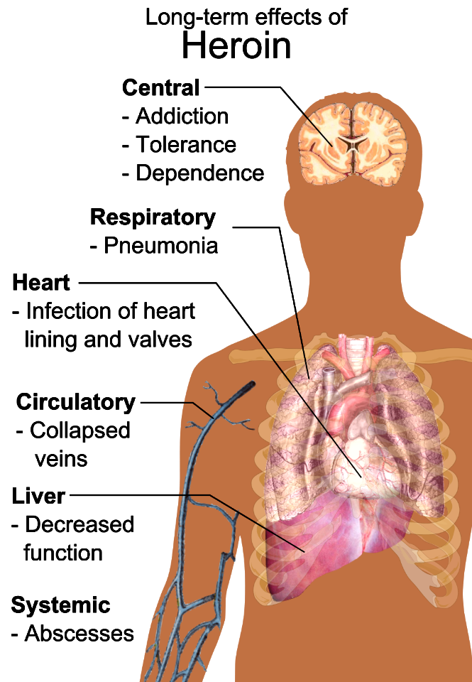 Long-term effects of heroin