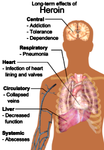 Long-term effects of heroin