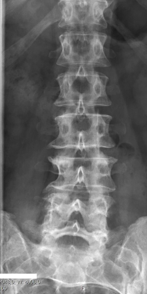 Lumbarization of S1
