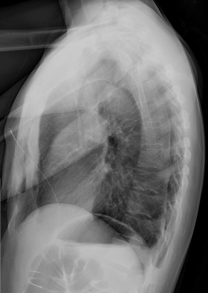 Lateral X-ray of pneumothorax in inspiration