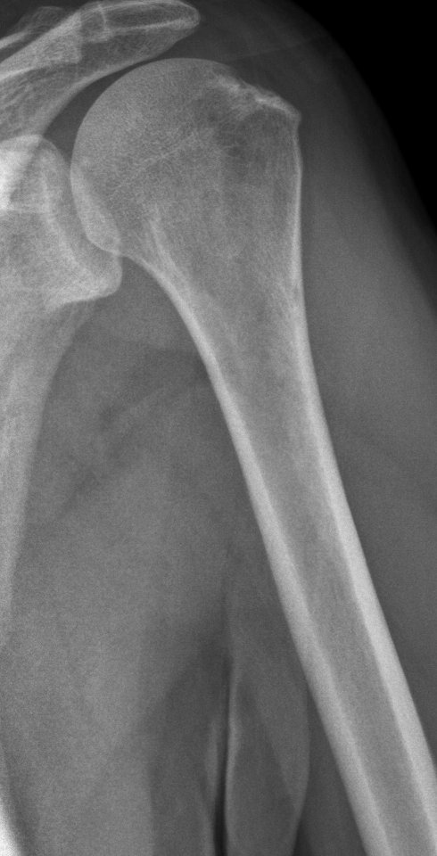 Left humerus with subtle signs of myeloma