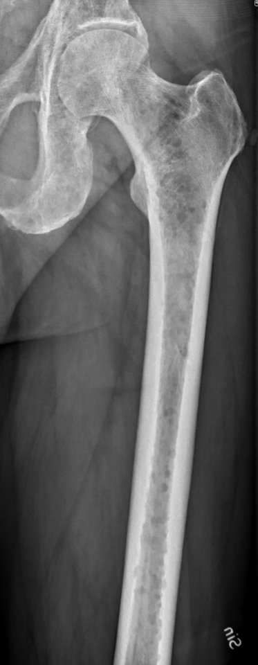 Left femur with myeloma
