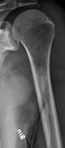 Left humerus with myeloma