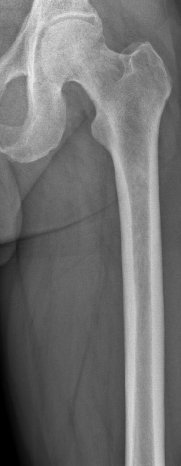 Left femur before myeloma
