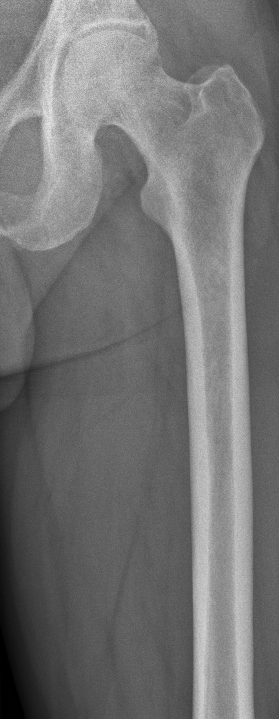 Left femur before myeloma