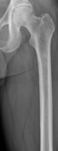 Left femur before myeloma photo