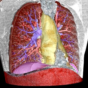 3D CT of thorax photo