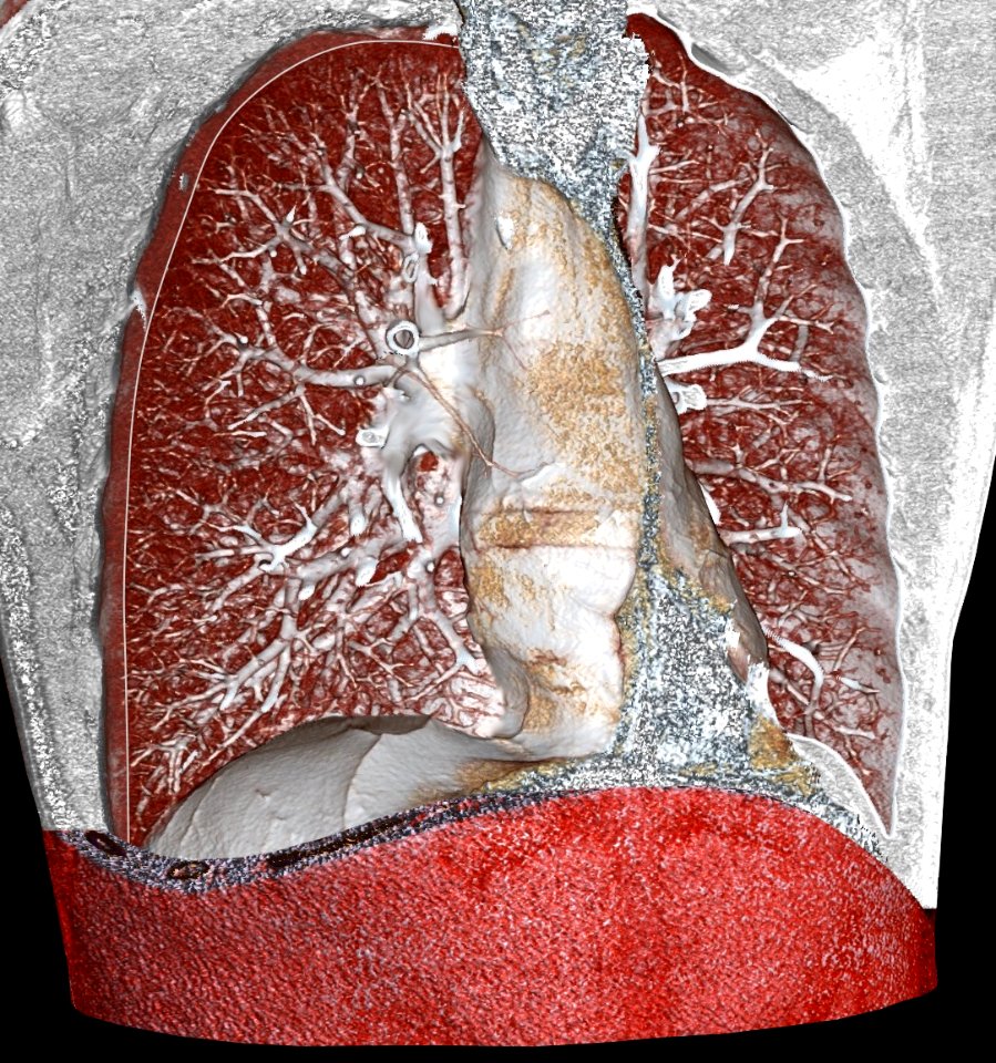 3D CT of pulmonary circulation