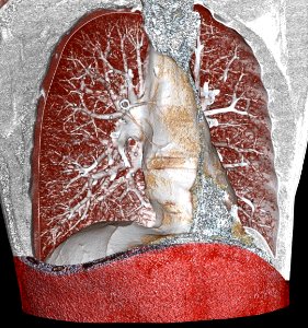 3D CT of pulmonary circulation
