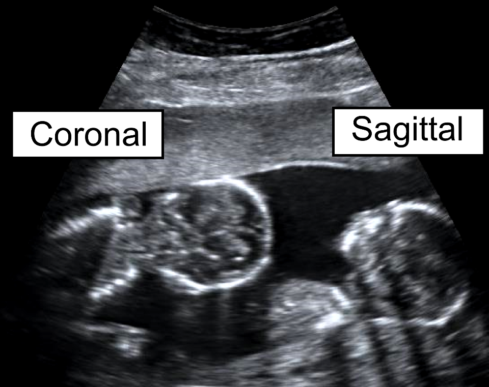 Coronal and sagittal views of identical twins