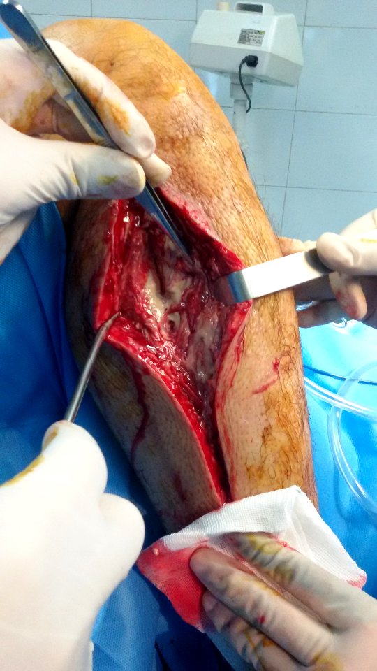 Compartment syndrome with fasciotomy procedure 02