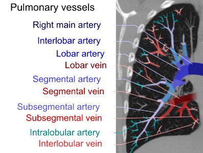 Computed tomograph of pulmonary vessels