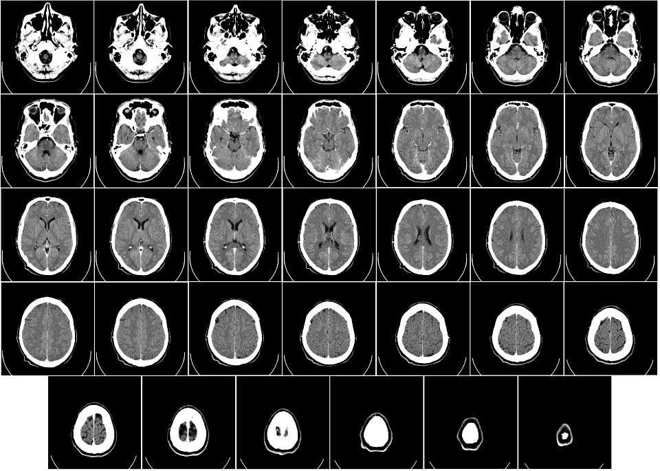 Computed tomography of human brain - large