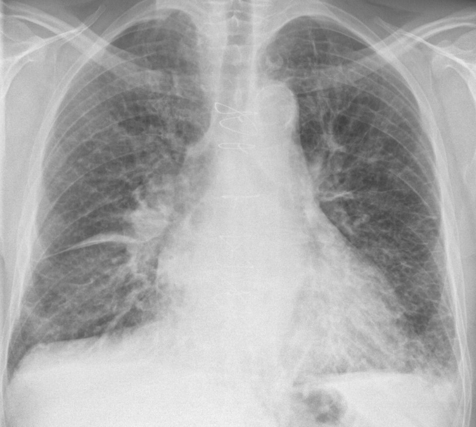 Chest radiograph of a lung with Kerley B lines