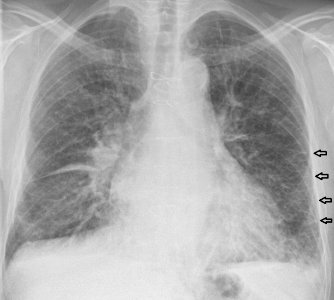 Chest radiograph of a lung with Kerley B lines - annotated photo