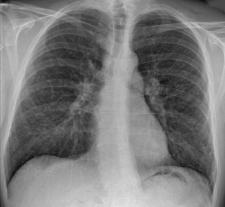 Chest X-ray of sarcoidosis nodules