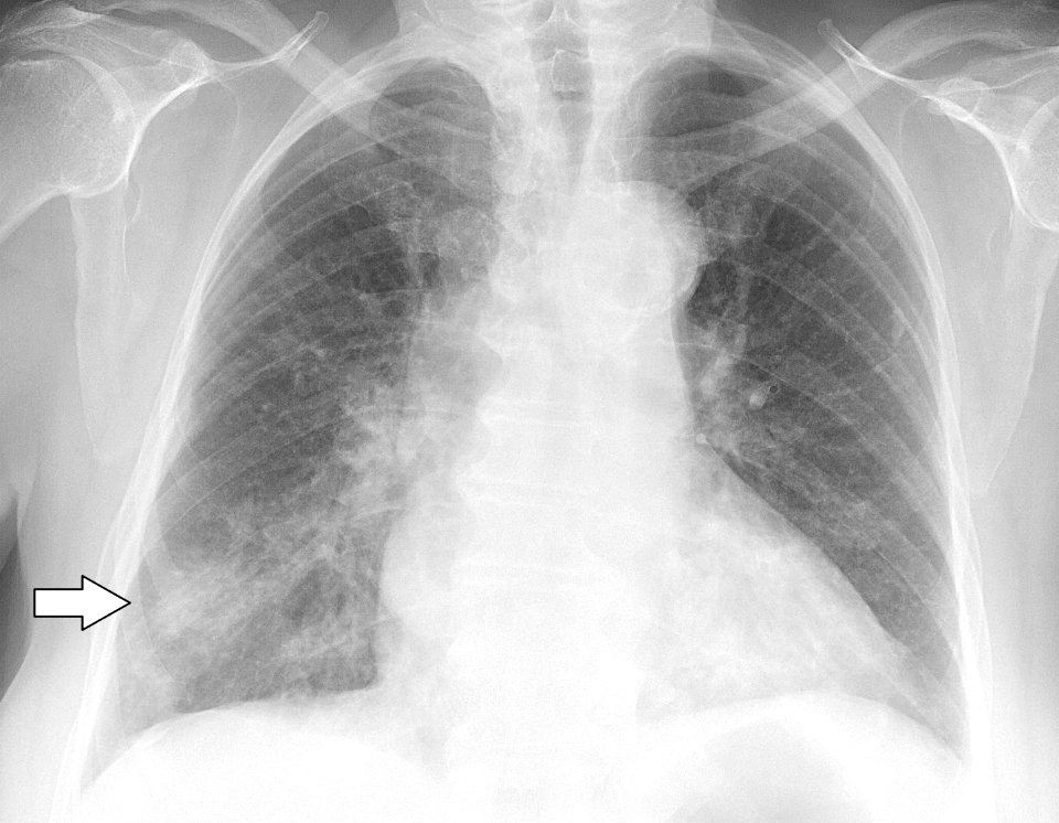 Chest X-ray in influenza and Haemophilus influenzae - annotated