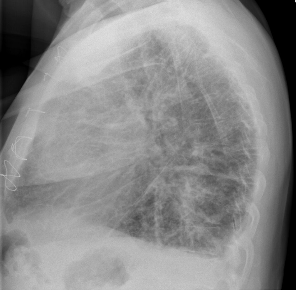 Chest radiograph of a lung with Kerley B lines - lateral