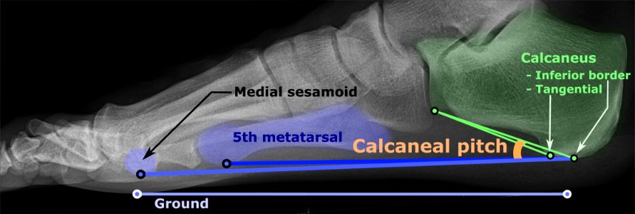 Calcaneal pitch photo